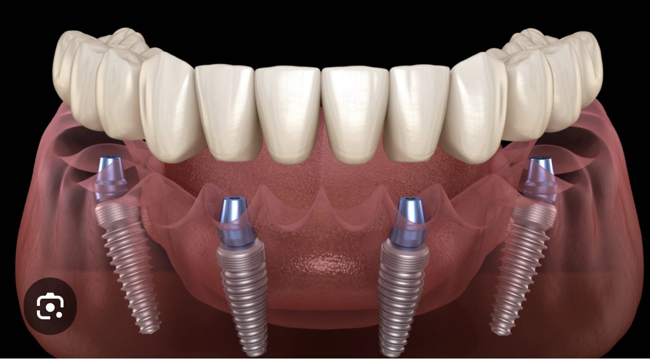 All-on-4 Dental Implant System