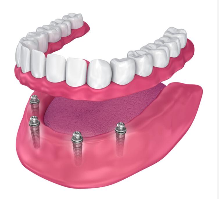 Dental Implants in Jaw Model