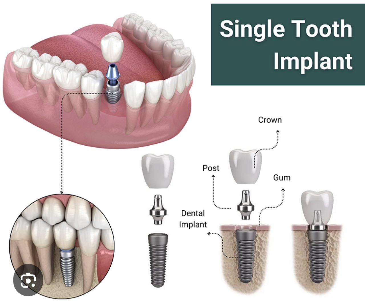 Single Tooth Implant Diagram